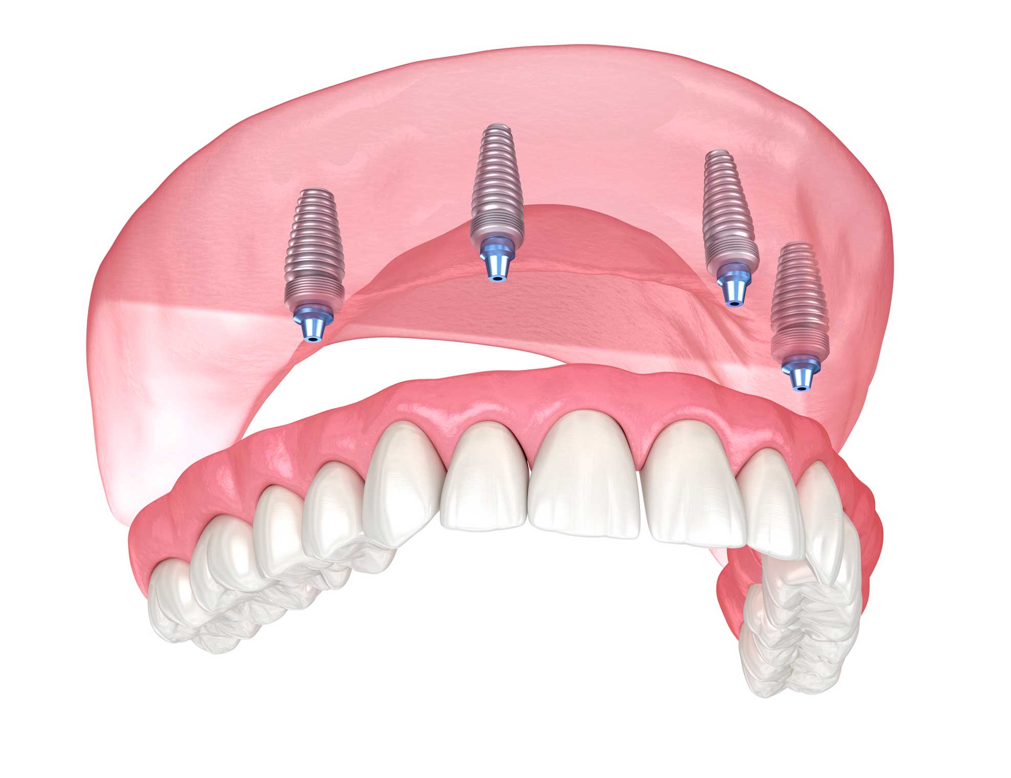 Dentista en Igualada, Clínica Dental en Igualada, implantología en Igualada