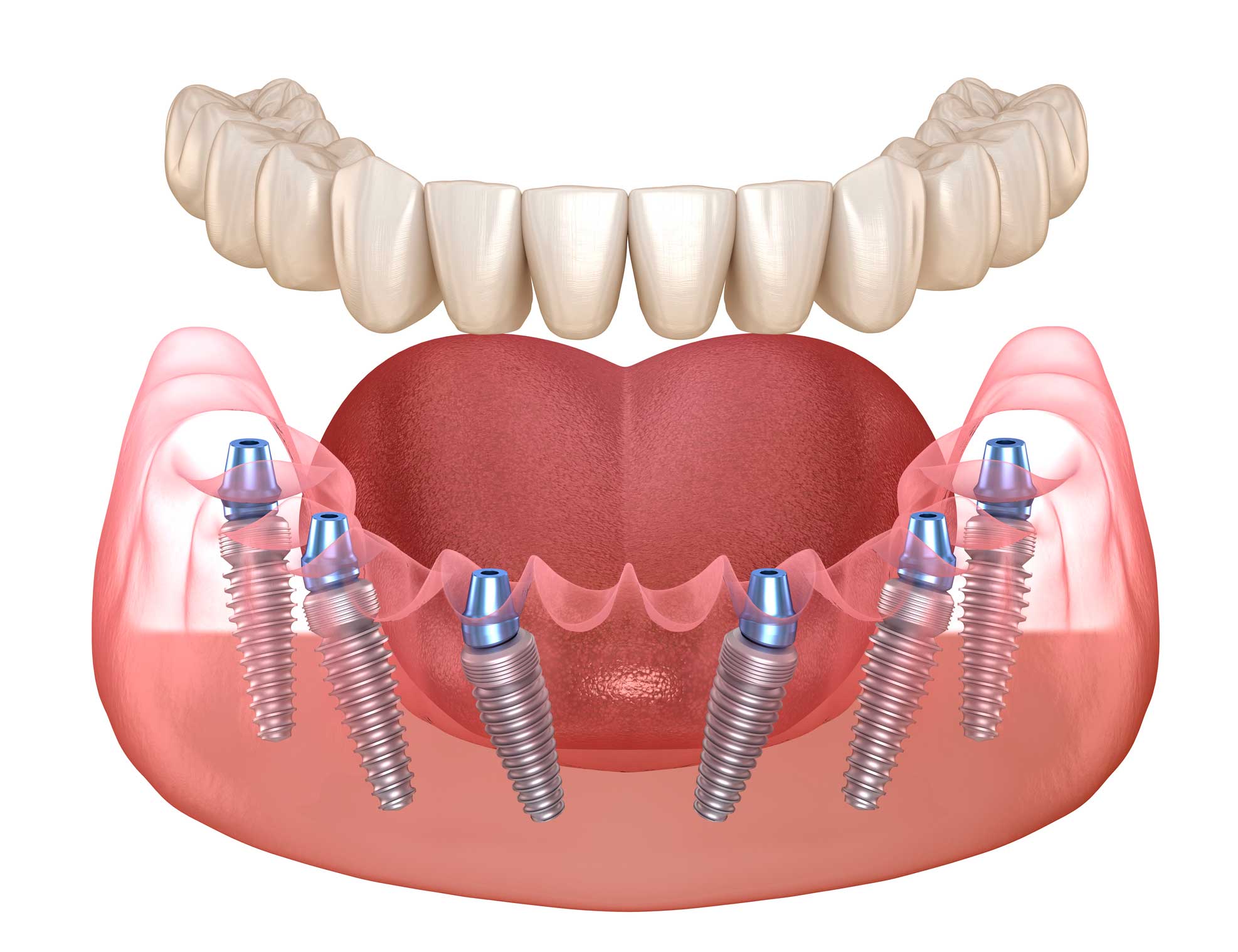 Dentista en Igualada, Clínica Dental en Igualada, implantología en Igualada
