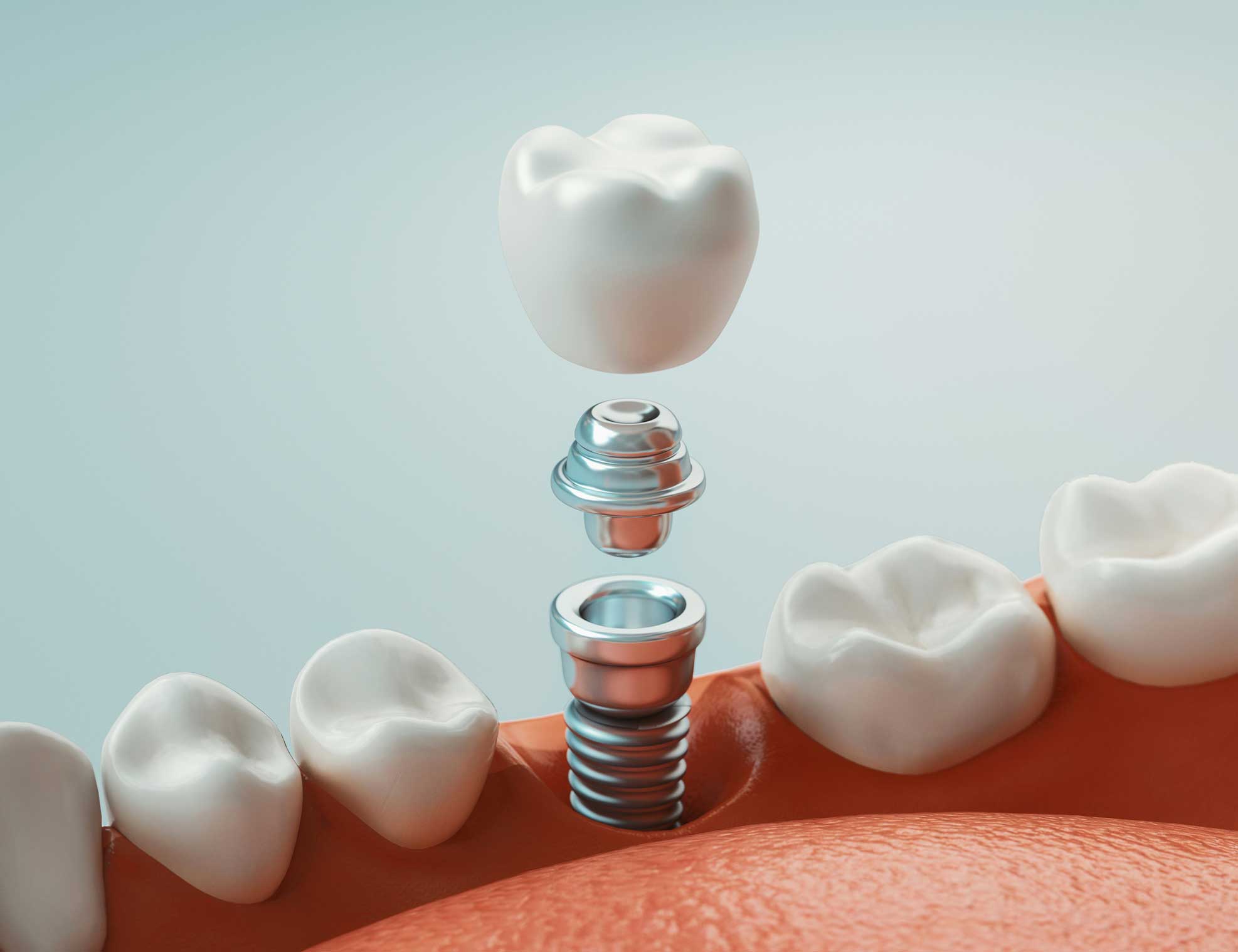Dentista en Igualada, Clínica Dental en Igualada, implantología en Igualada