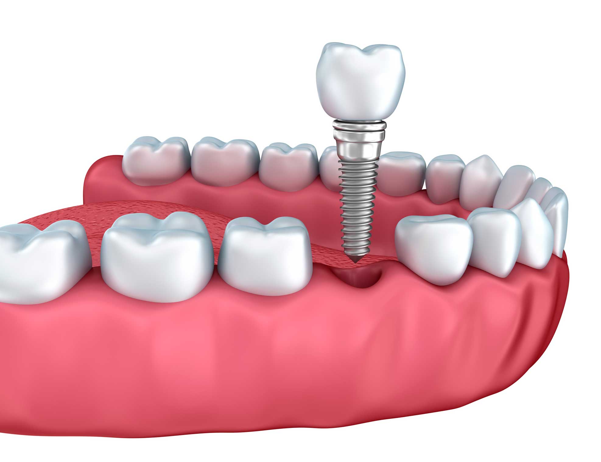 Dentista en Igualada, Clínica Dental en Igualada, implantología en Igualada