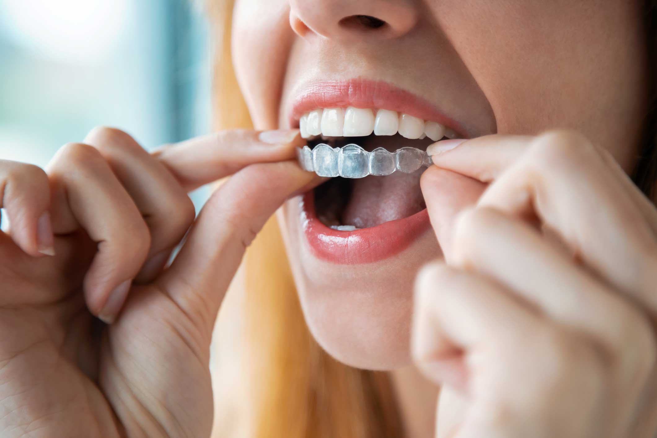 Dentista en Igualada, Clínica Dental en Igualada, ortodoncia en Igualada