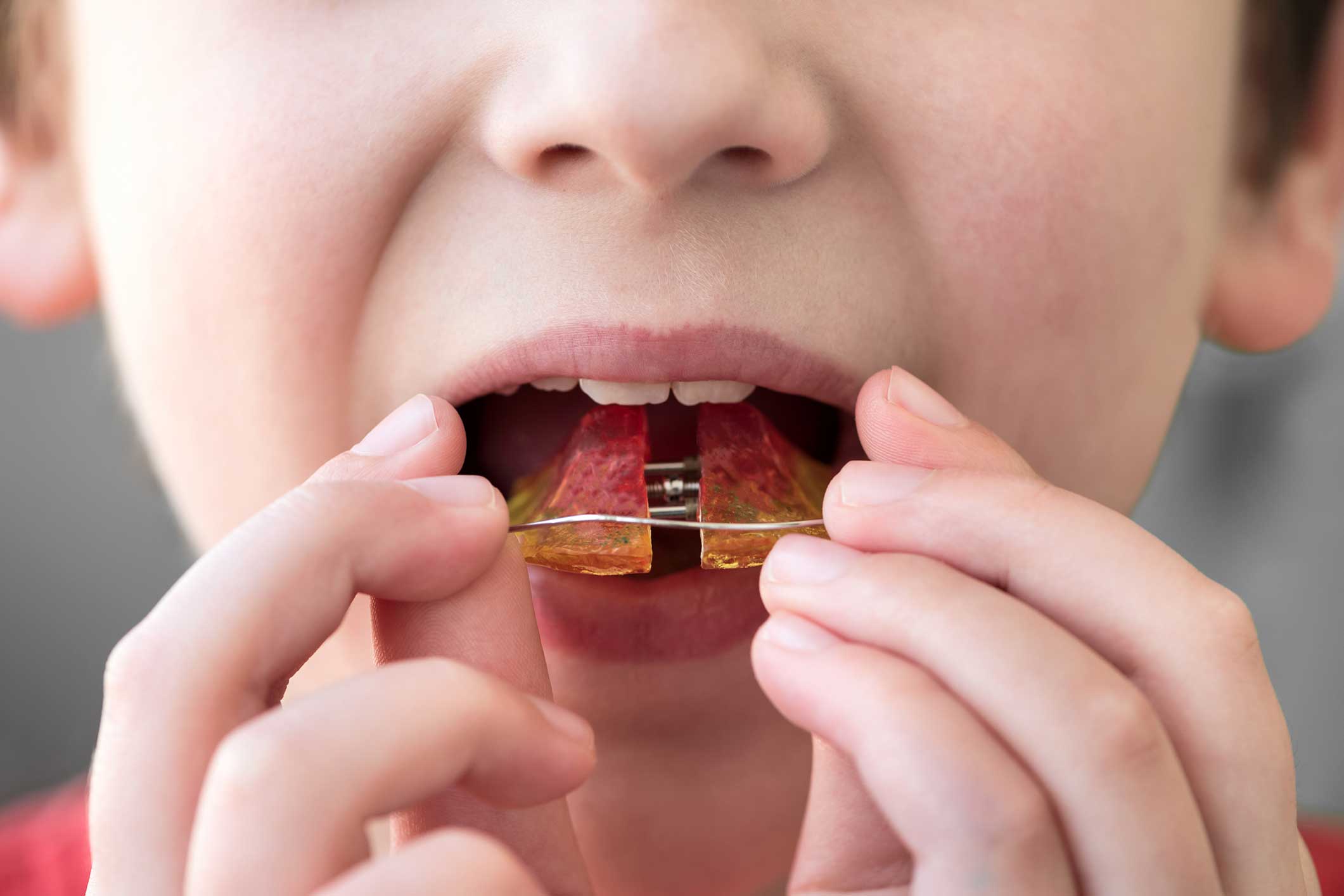 Dentista en Igualada, Clínica Dental en Igualada, ortopedia dental en Igualada