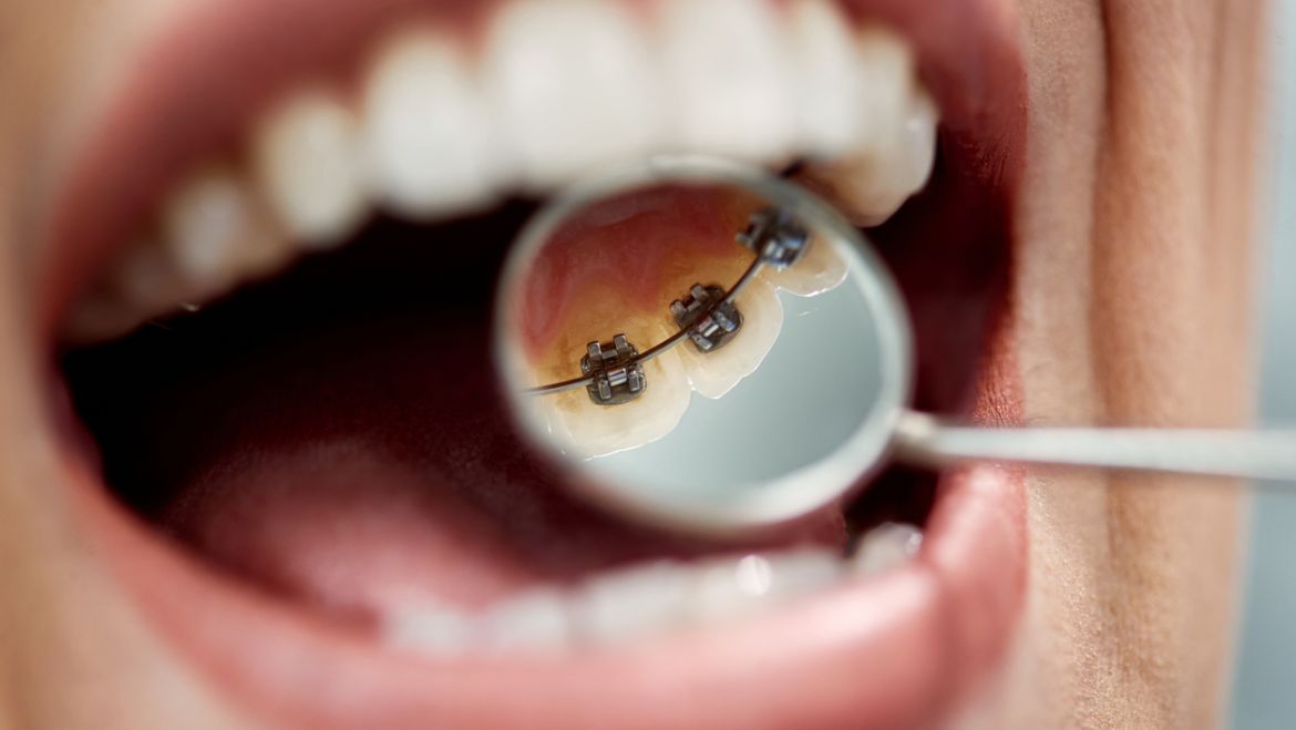 ¿Conoces la ortodoncia lingual?