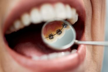 ¿Conoces la ortodoncia lingual?