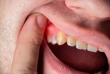 ¿Por qué puede aparecer una fístula en la encía?